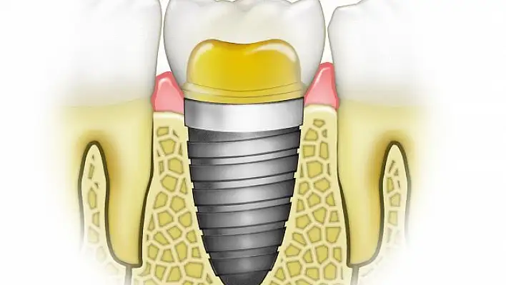 İmplant ile ilgili merak edilen 6 soru