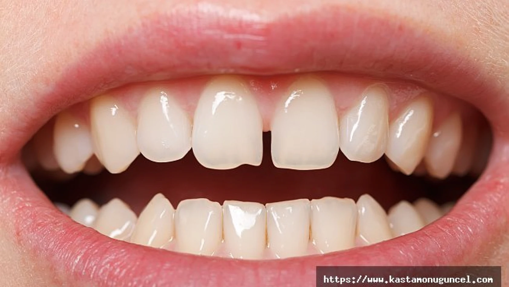 Ayrık dişler için çözüm Bonding tedavisi